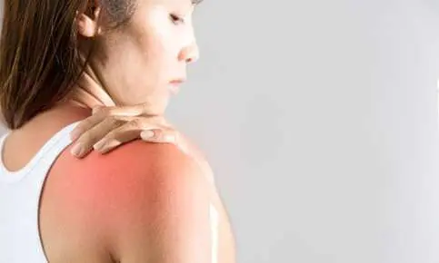 Sunburned skin on woman's shoulder