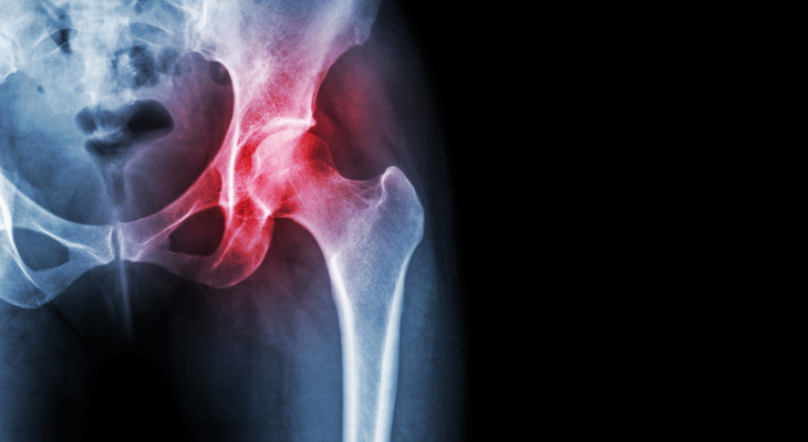 Hip bone X-ray showing inflammation