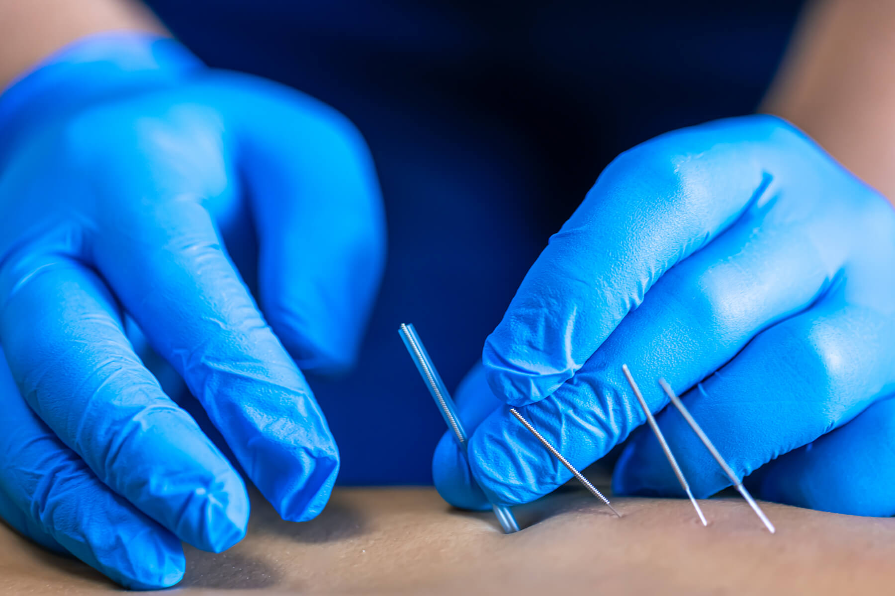 Gloved hands performing acupuncture therapy
