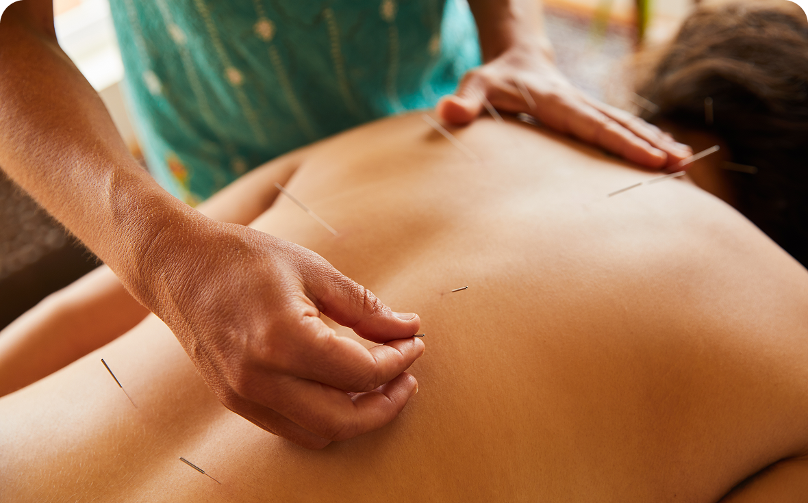Therapist performing acupuncture treatment