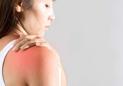 Sunburned skin on woman's shoulder