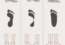Diagram of foot arch variations