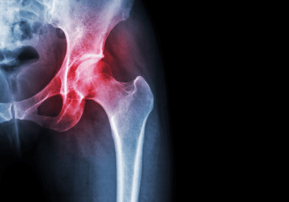 Hip bone X-ray showing inflammation